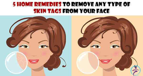 5 Home Remedies to Remove Any Type of Skin Tags from Your Face (1)