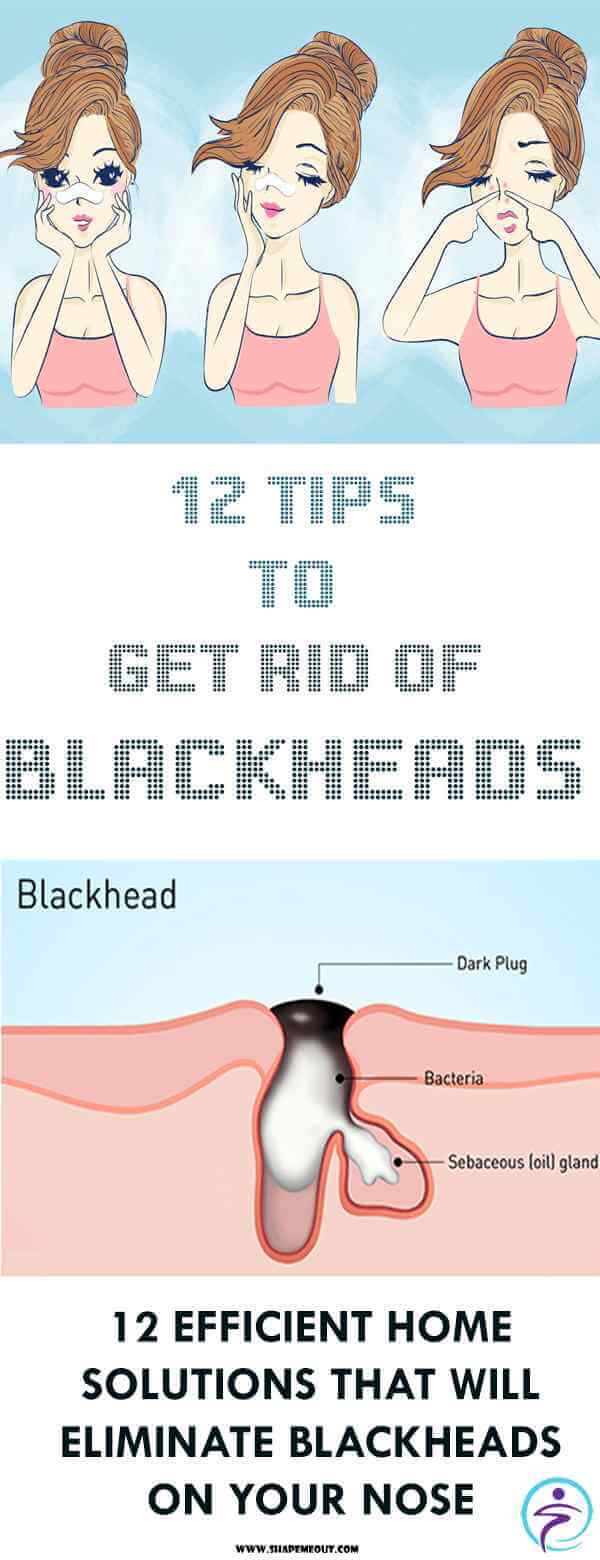 12 Tips to Get Rid of Blackheads