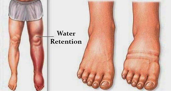 fluid retention