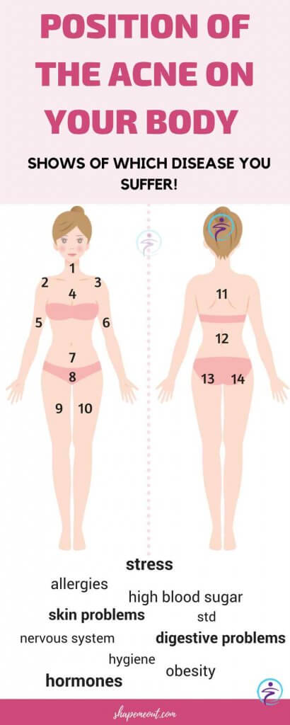 POSITION OF THE ACNE ON YOUR BODY