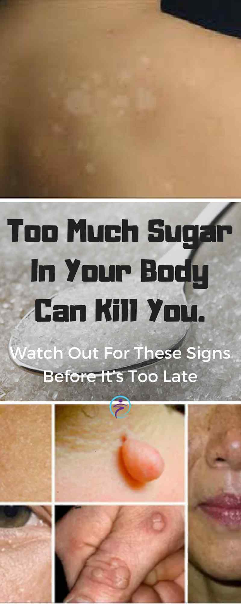 Too Much Sugar In Your Body Can Kill You. Watch Out For These Signs Before It’s Too Late